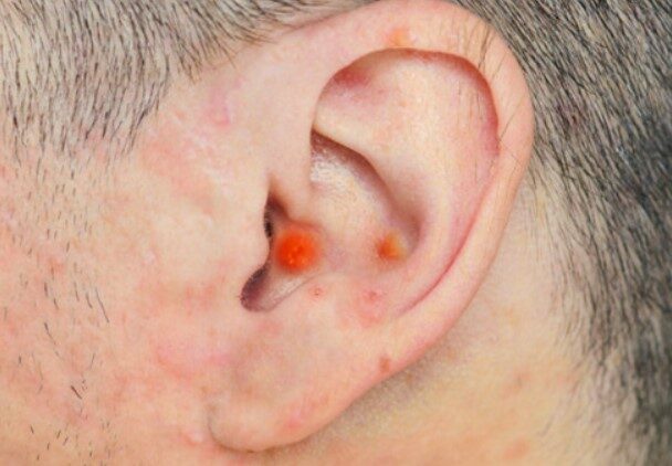 Effective Natural Remedies For Treating Ear Pimples