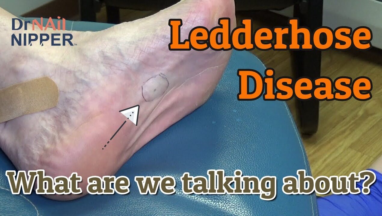 What is ledderhose disease