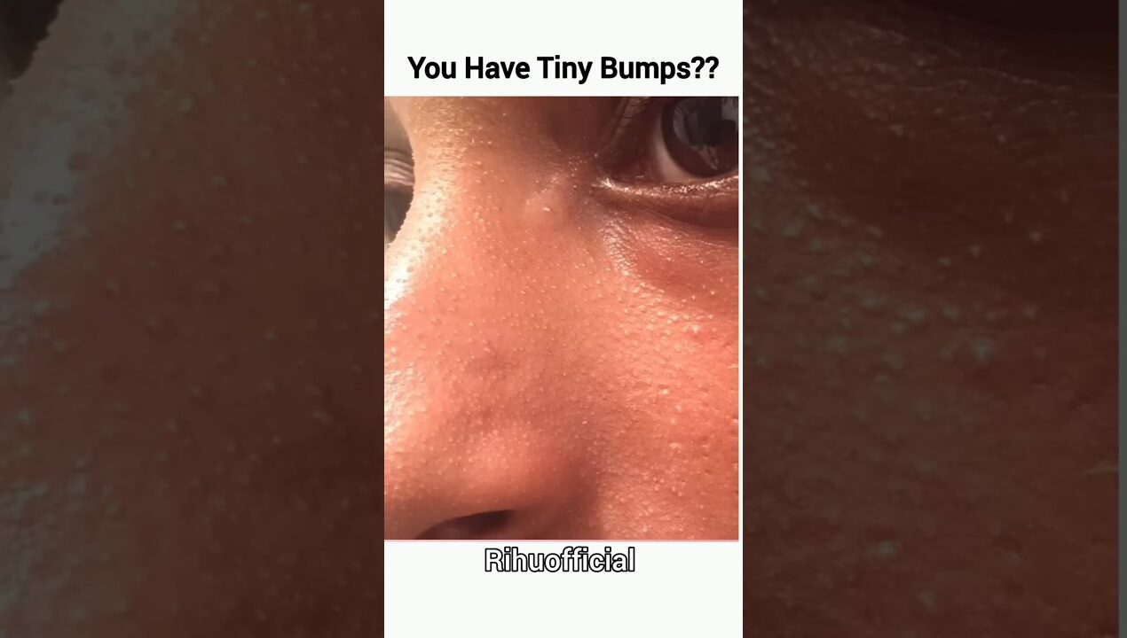 😱Skin par tiny bumps? Try this remedy / Skincare Tips #shortsfeed #skincare #viral #shorts #ytshorts