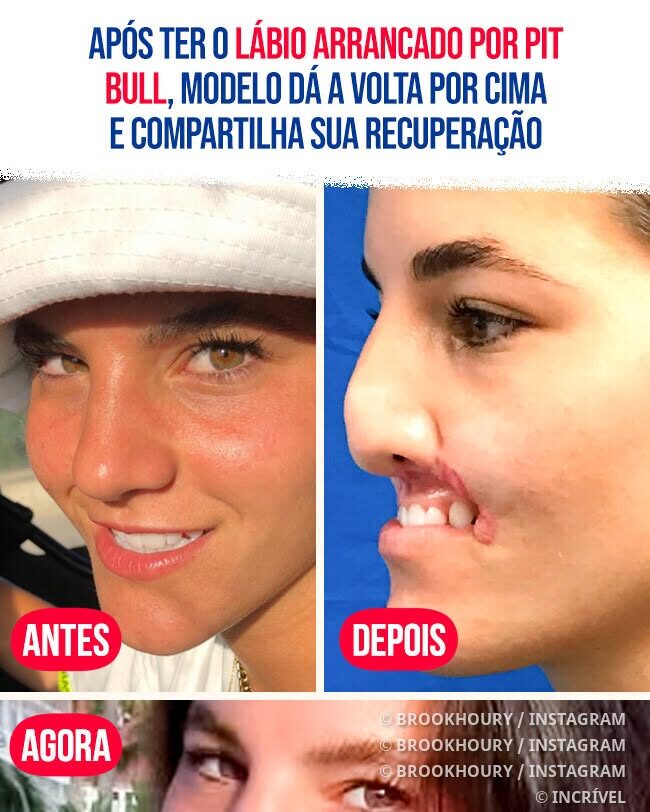 Tras sufrir un ataque de pitbull que le arrancó el labio, la modelo se recupera y comparte su historia de recuperación.