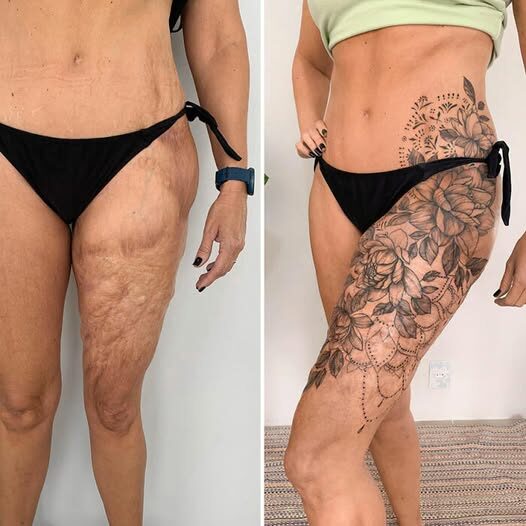Healing Through Art: How Tattoo Artist Raquel Sousa Transforms Scars Into Beautiful Masterpieces