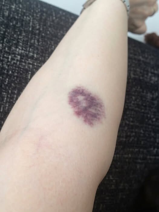 Unexplained Bruises: When Should You Be Concerned?