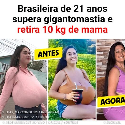 Overcoming Gigantomastia: How a 21-Year-Old Brazilian Woman Reclaimed Her Life After Removing 10 kg of Breast Tissue