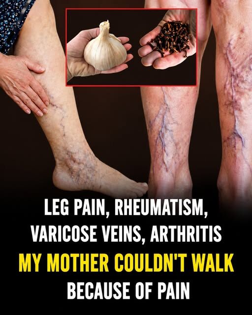 Natural Relief for Joint Pain and Varicose Veins: A Simple Garlic and Clove Oil Remedy